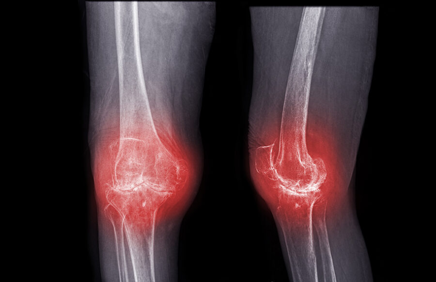 la osteoartritis se caracterizada por dolor articular al movimiento